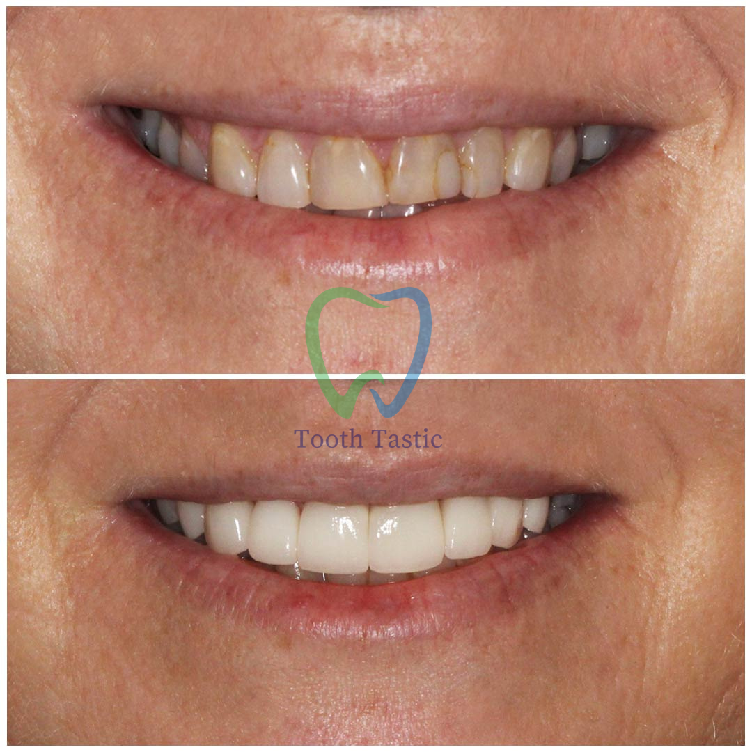 smiling-dental-porcelain-veneers-before-after-