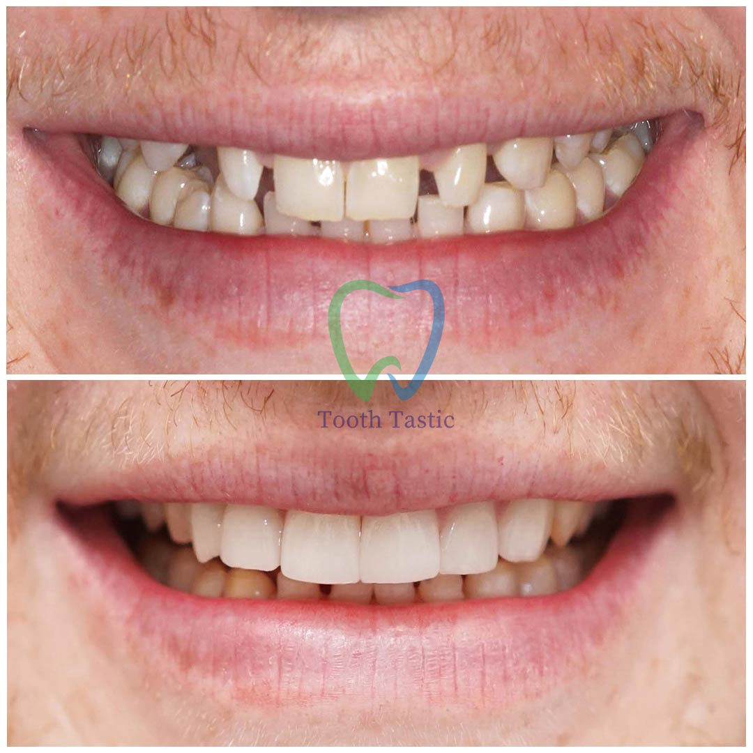 smiling-dental-porcelain-veneers-before-after-10