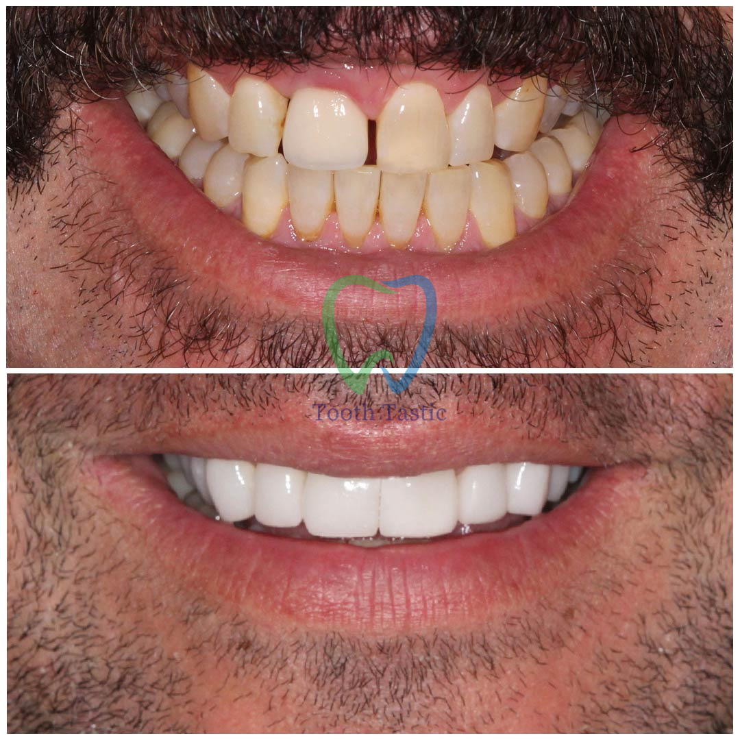 smiling-dental-porcelain-veneers-before-after-6