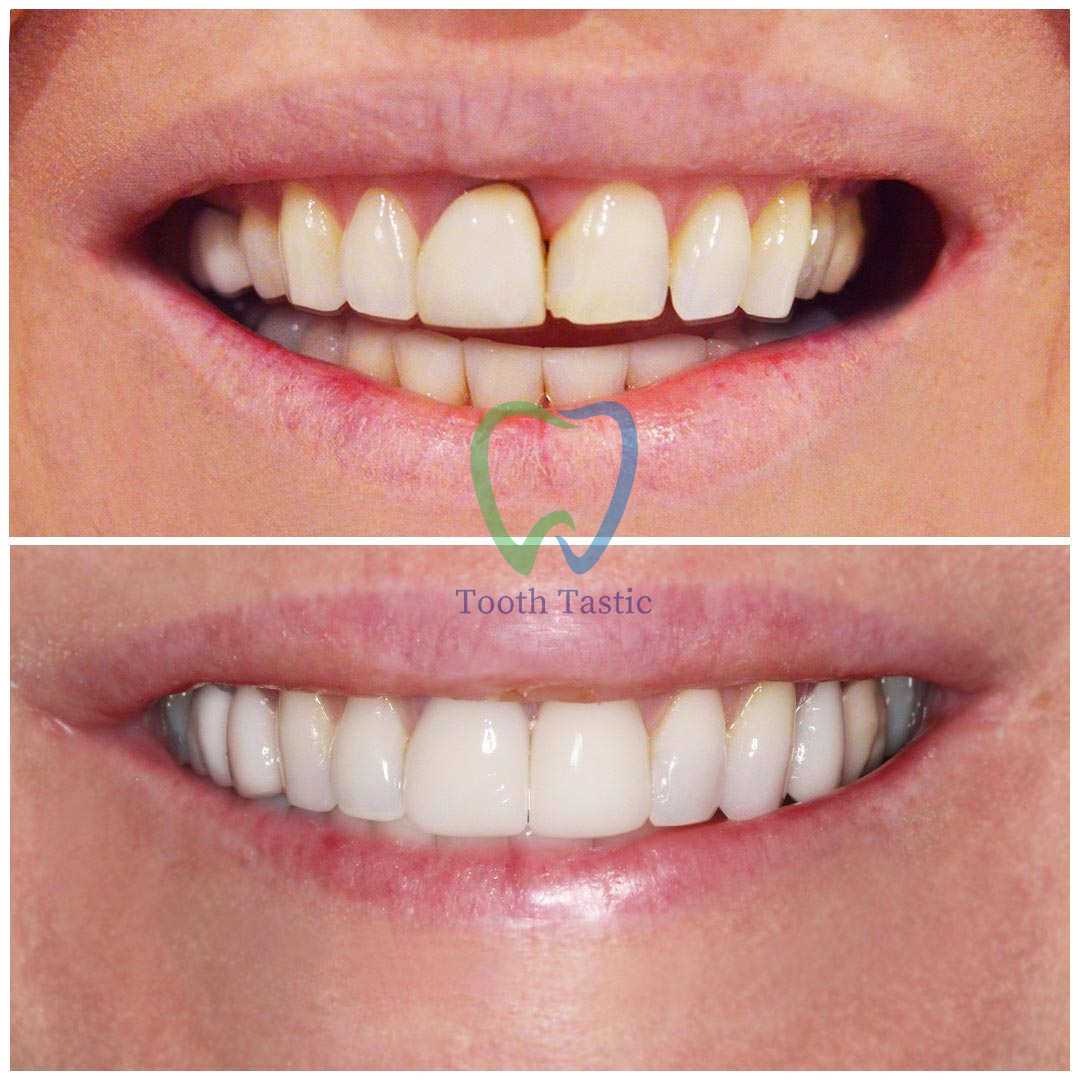 smiling-dental-porcelain-veneers-before-after-5