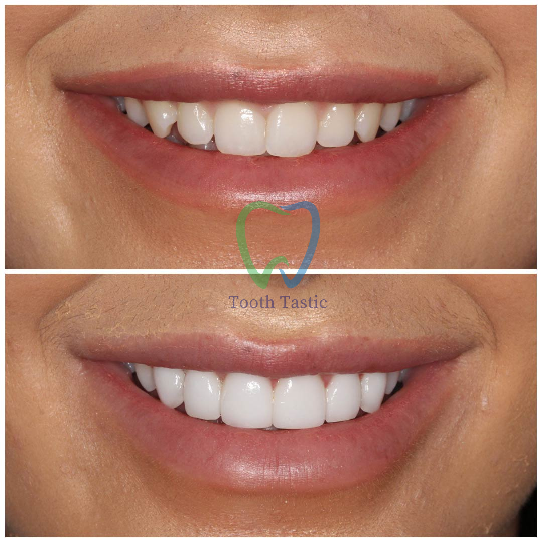 smiling-dental-porcelain-veneers-before-after-2