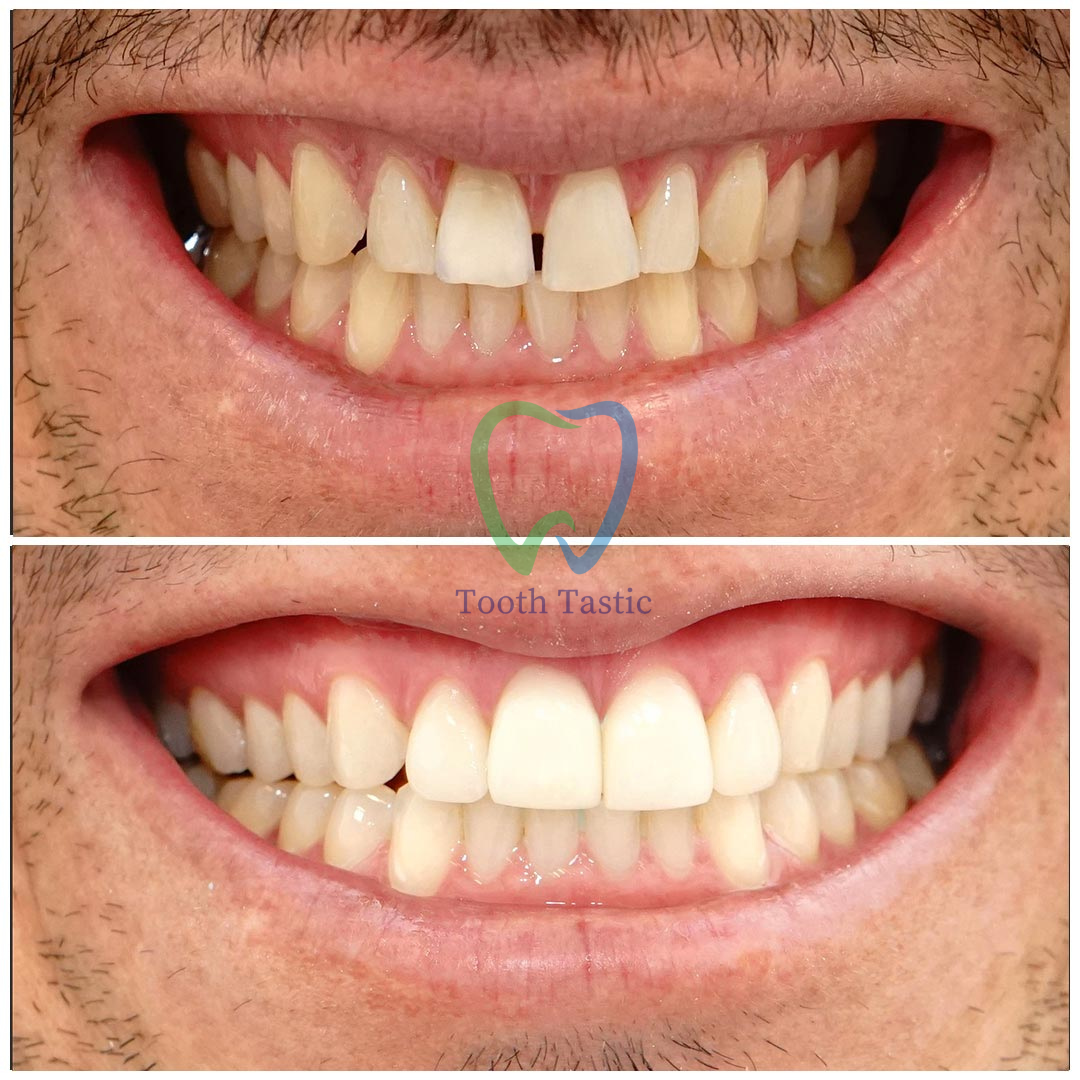 smiling-dental-porcelain-veneers-before-after-