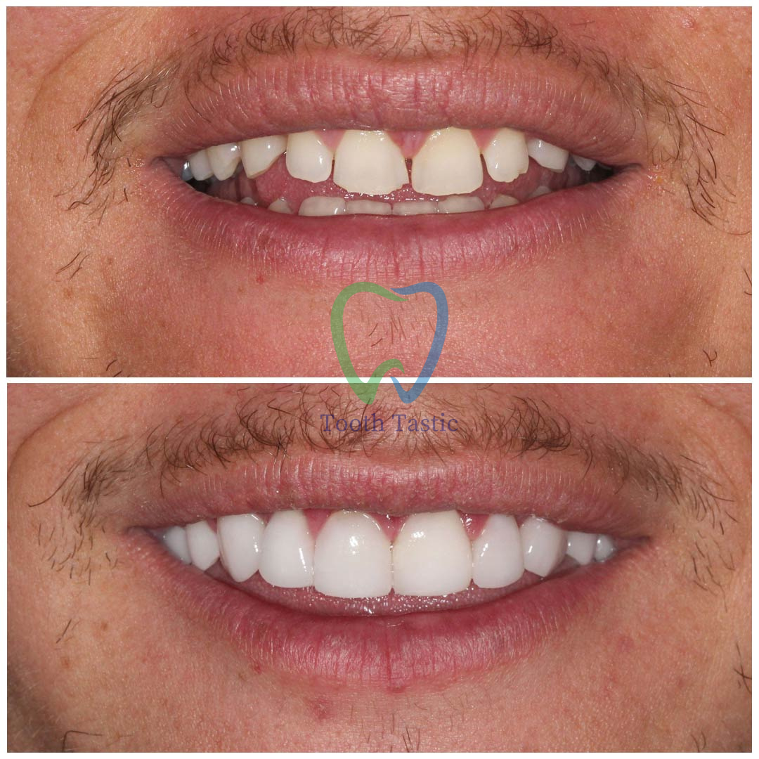 smiling-dental-porcelain-veneers-before-after-5