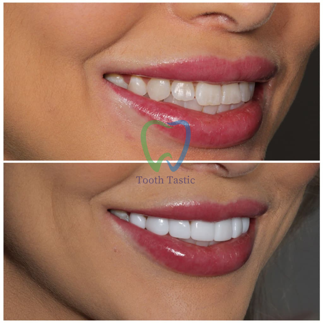 smiling-dental-porcelain-veneers-before-after-6