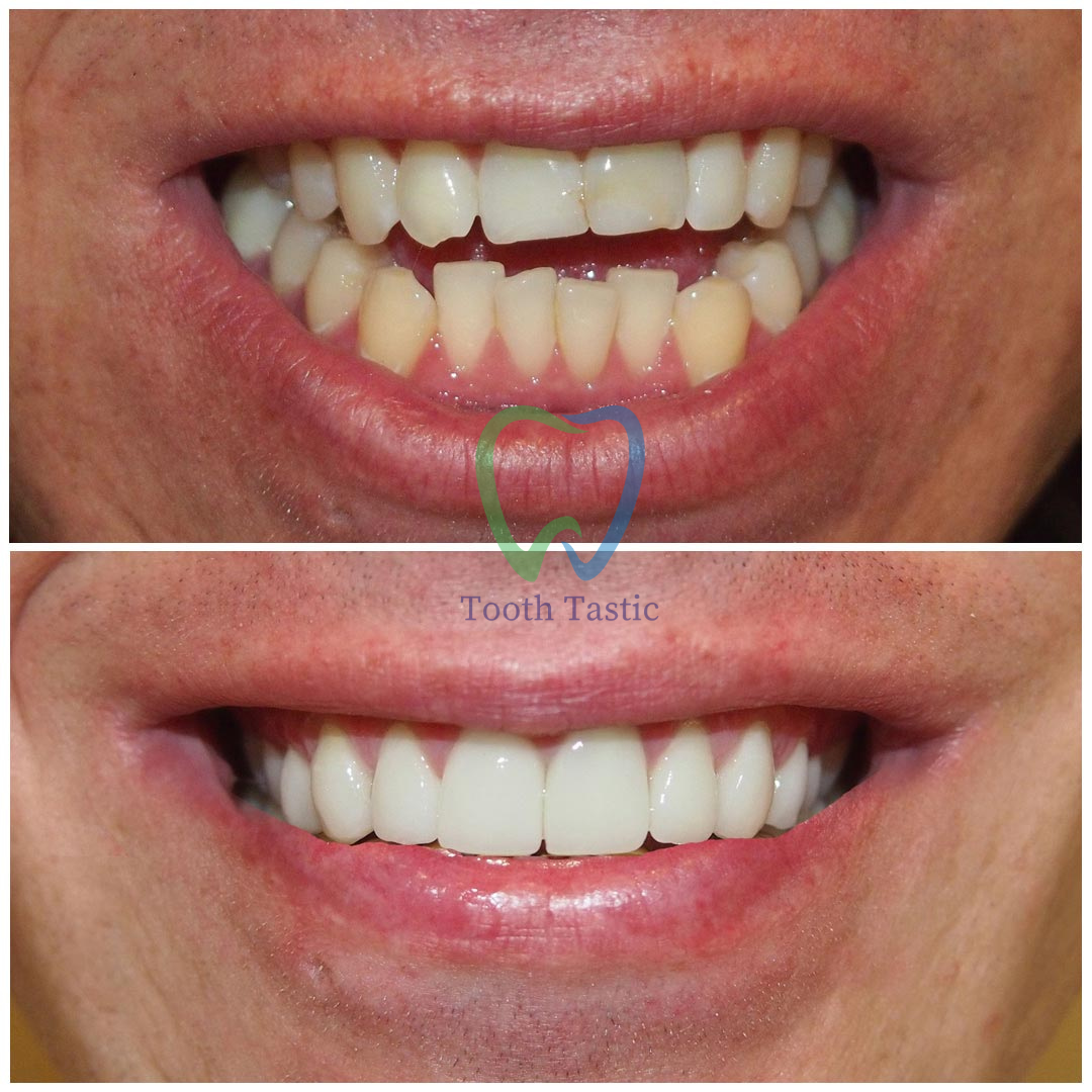 smiling-dental-porcelain-veneers-before-after-7